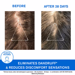 Ds Champú Caspa Moderada con Piroctona Olamina - Elimina la Caspa Seca y Grasa 200 ml - Vue supplémentaire 4