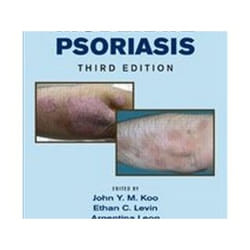 ISBN Mild to Moderate Psoriasis 3E livre Médical Anglais Couverture rigide
